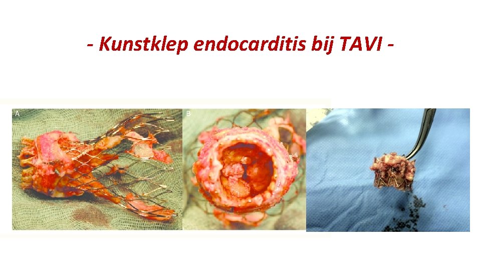 - Kunstklep endocarditis bij TAVI - 