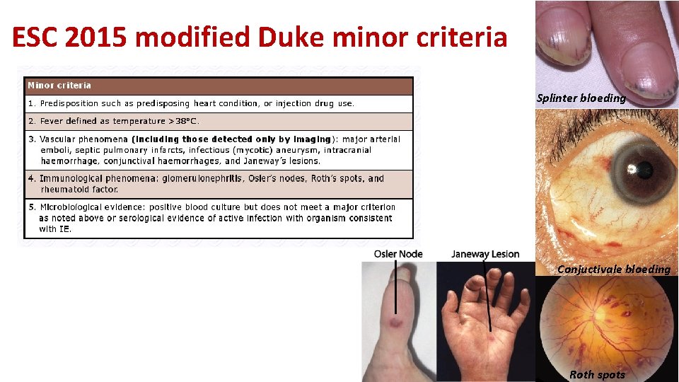 ESC 2015 modified Duke minor criteria Splinter bloeding Conjuctivale bloeding Roth spots 