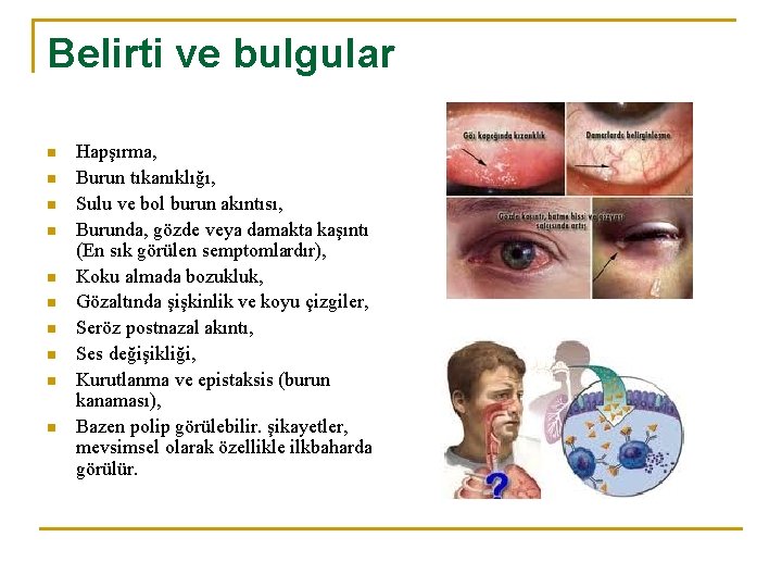 Belirti ve bulgular n n n n n Hapşırma, Burun tıkanıklığı, Sulu ve bol