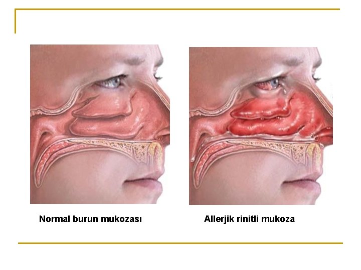 Normal burun mukozası Allerjik rinitli mukoza 