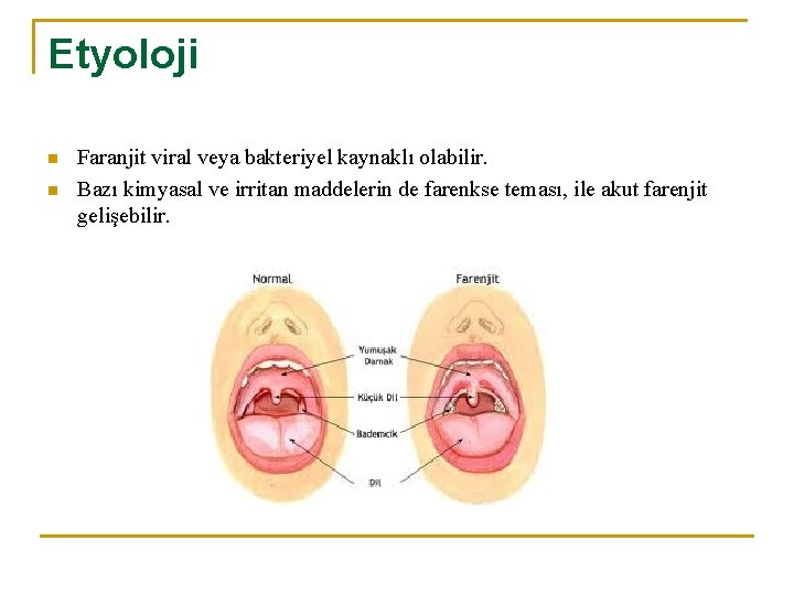 Etyoloji n n Faranjit viral veya bakteriyel kaynaklı olabilir. Bazı kimyasal ve irritan maddelerin