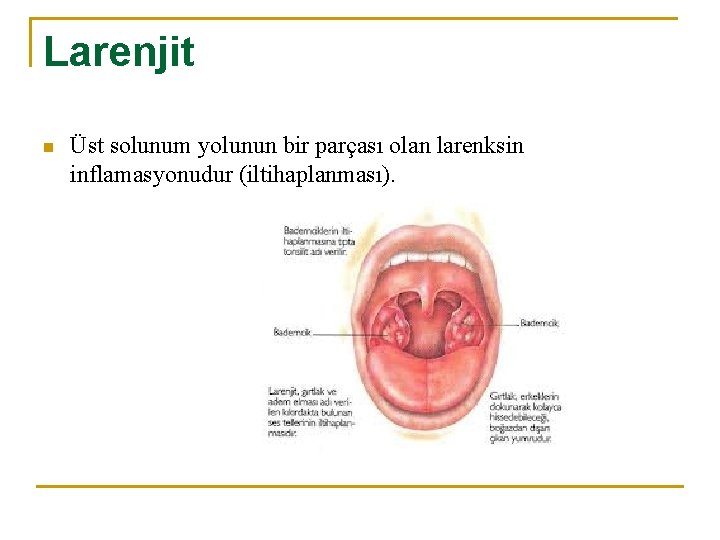 Larenjit n Üst solunum yolunun bir parçası olan larenksin inflamasyonudur (iltihaplanması). 