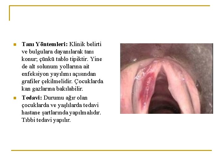 n n Tanı Yöntemleri: Klinik belirti ve bulgulara dayanılarak tanı konur; çünkü tablo tipiktir.