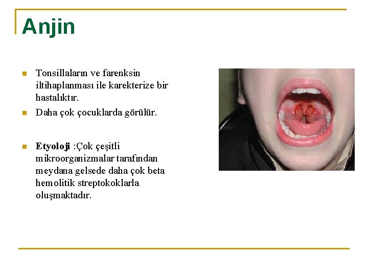 Anjin n Tonsillaların ve farenksin iltihaplanması ile karekterize bir hastalıktır. Daha çok çocuklarda görülür.