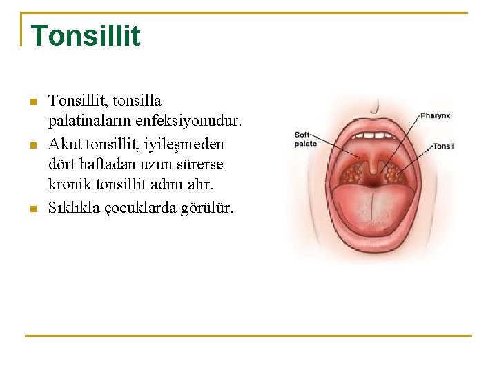 Tonsillit n n n Tonsillit, tonsilla palatinaların enfeksiyonudur. Akut tonsillit, iyileşmeden dört haftadan uzun