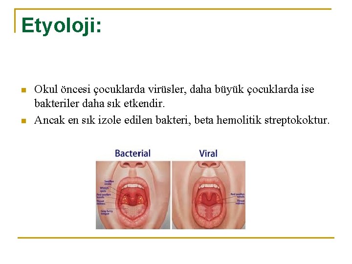 Etyoloji: n n Okul öncesi çocuklarda virüsler, daha büyük çocuklarda ise bakteriler daha sık