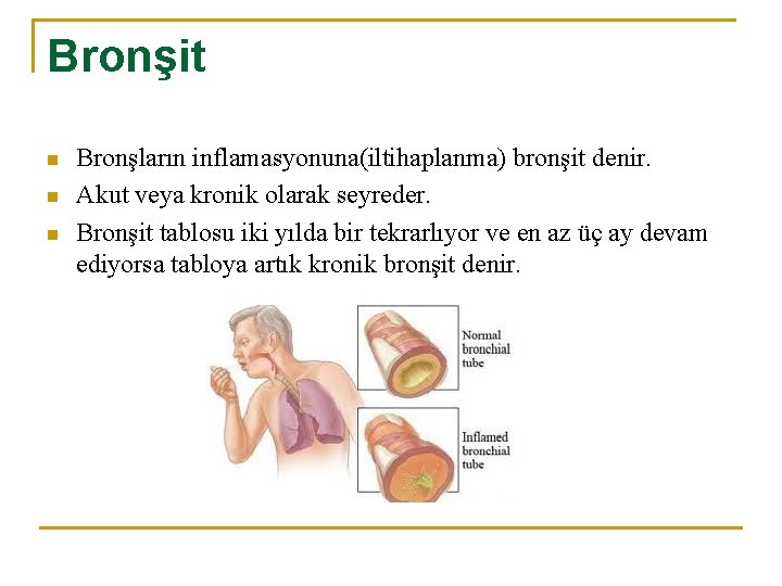 Bronşit n n n Bronşların inflamasyonuna(iltihaplanma) bronşit denir. Akut veya kronik olarak seyreder. Bronşit
