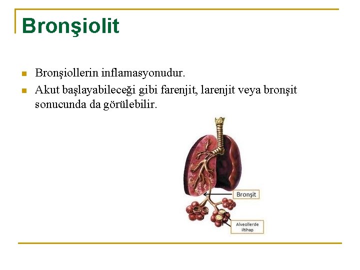 Bronşiolit n n Bronşiollerin inflamasyonudur. Akut başlayabileceği gibi farenjit, larenjit veya bronşit sonucunda da