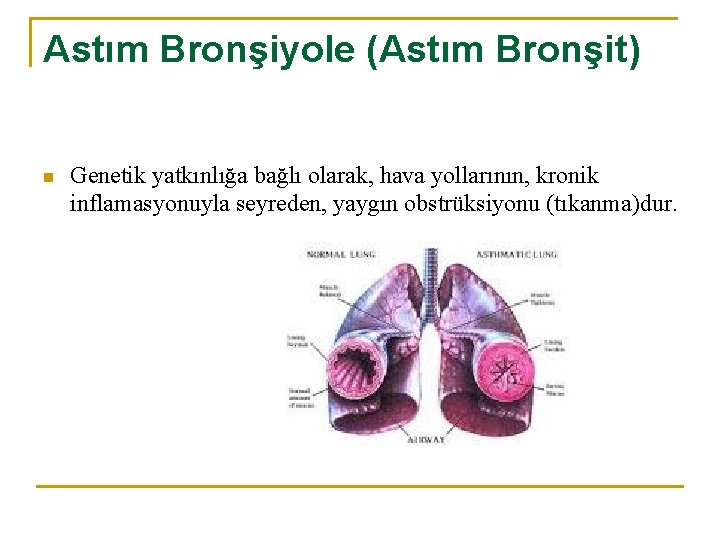 Astım Bronşiyole (Astım Bronşit) n Genetik yatkınlığa bağlı olarak, hava yollarının, kronik inflamasyonuyla seyreden,