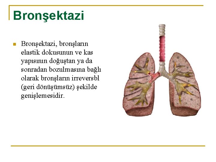 Bronşektazi n Bronşektazi, bronşların elastik dokusunun ve kas yapısının doğuştan ya da sonradan bozulmasına