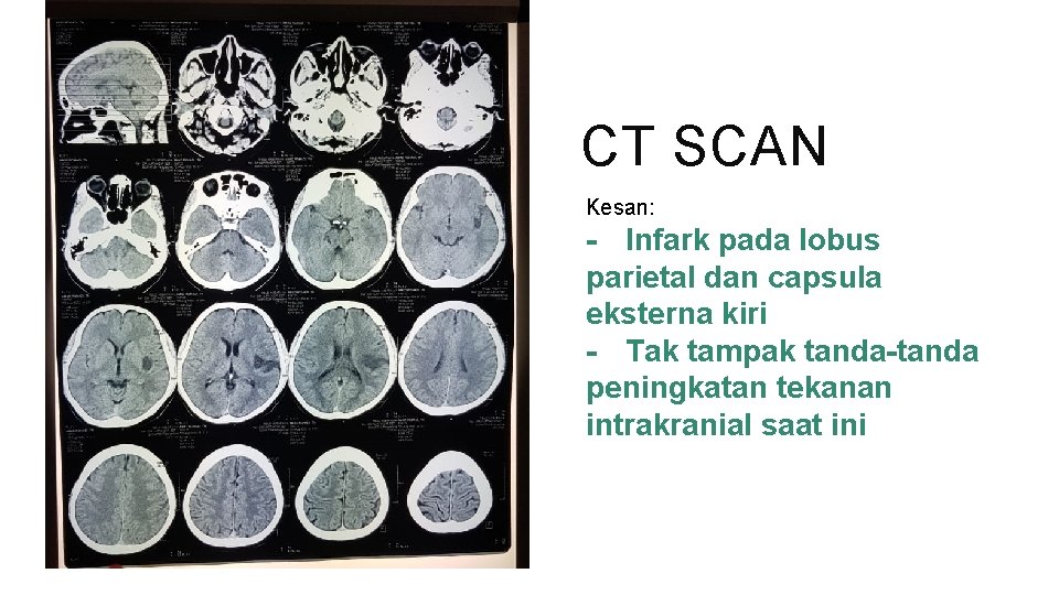 CT SCAN Kesan: - Infark pada lobus parietal dan capsula eksterna kiri - Tak