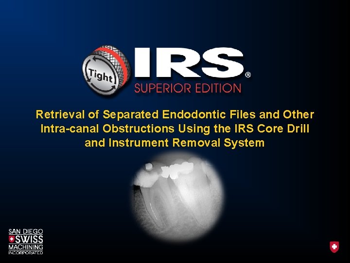 Retrieval of Separated Endodontic Files and Other Intra-canal Obstructions Using the IRS Core Drill