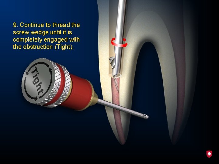 9. Continue to thread the screw wedge until it is completely engaged with the