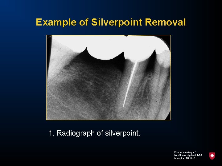 Example of Silverpoint Removal 1. Radiograph of silverpoint. Photo’s courtesy of: Dr. Charles Agriesti,