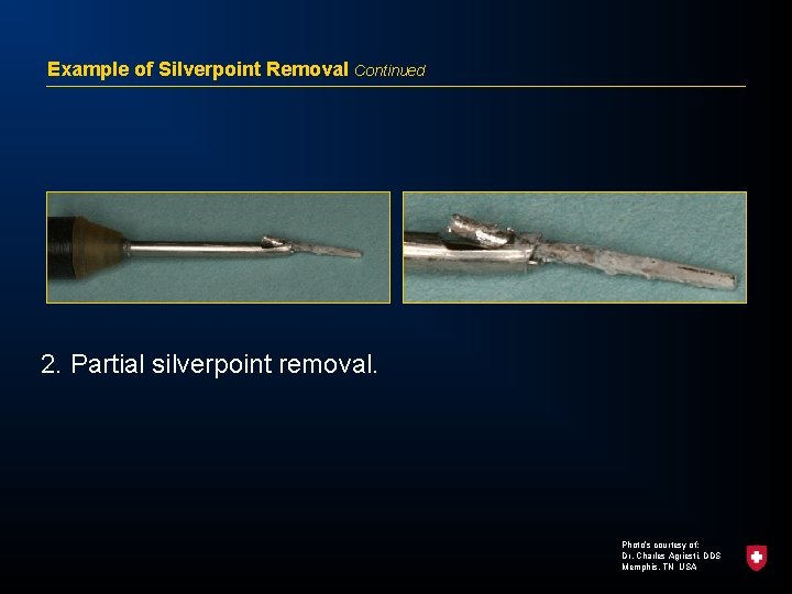 Example of Silverpoint Removal Continued 2. Partial silverpoint removal. Photo’s courtesy of: Dr. Charles