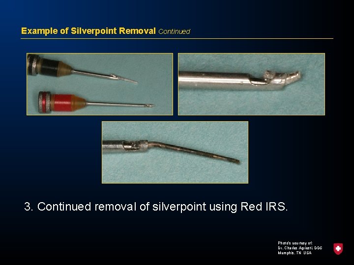 Example of Silverpoint Removal Continued 3. Continued removal of silverpoint using Red IRS. Photo’s