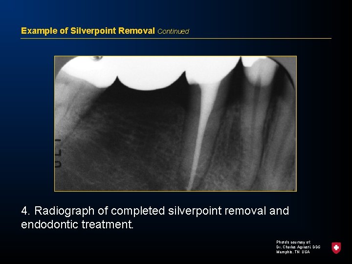 Example of Silverpoint Removal Continued 4. Radiograph of completed silverpoint removal and endodontic treatment.