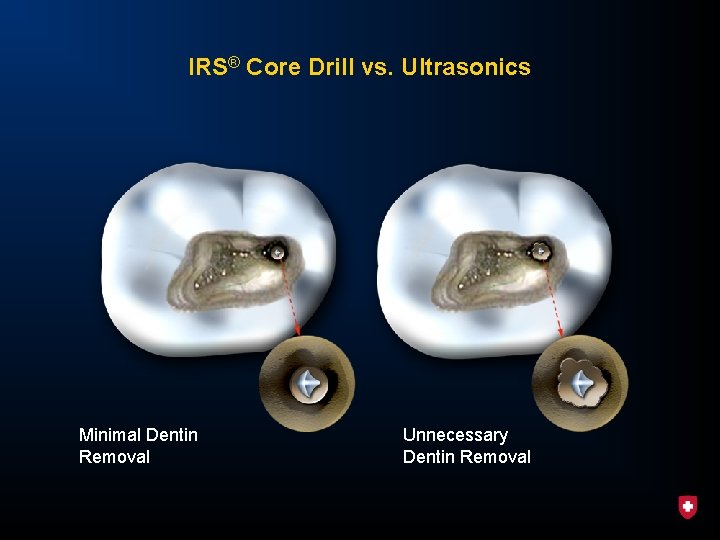 IRS® Core Drill vs. Ultrasonics Minimal Dentin Removal Unnecessary Dentin Removal 