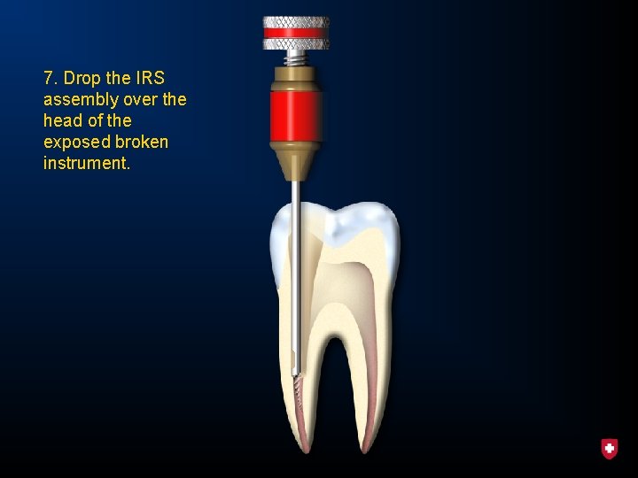 7. Drop the IRS assembly over the head of the exposed broken instrument. 