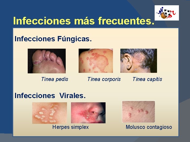 Infecciones más frecuentes. Infecciones Fúngicas. Tinea pedis Tinea corporis Tinea capitis Infecciones Virales. Herpes