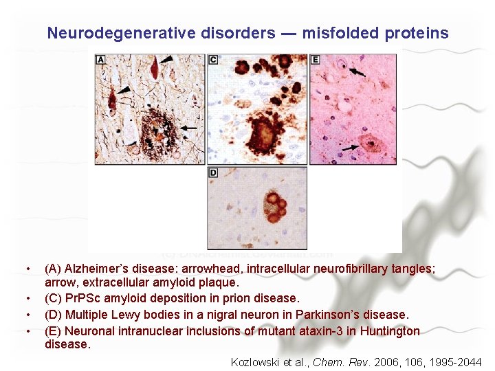 Neurodegenerative disorders ― misfolded proteins • • (A) Alzheimer’s disease: arrowhead, intracellular neurofibrillary tangles;