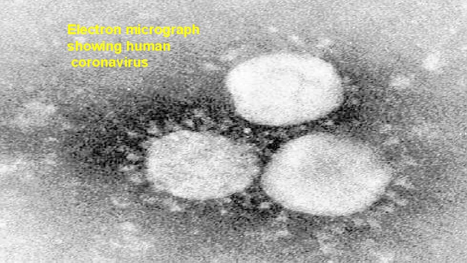 Electron micrograph showing human coronavirus 