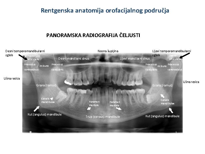 Rentgenska anatomija orofacijalnog područja PANORAMSKA RADIOGRAFIJA ČELJUSTI Desni temporomandibularni zglob Fovea Nosna šupljina Desni