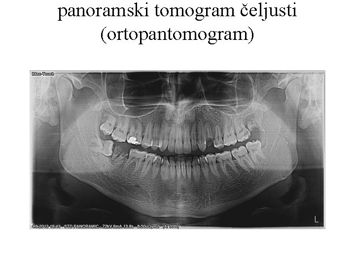panoramski tomogram čeljusti (ortopantomogram) 