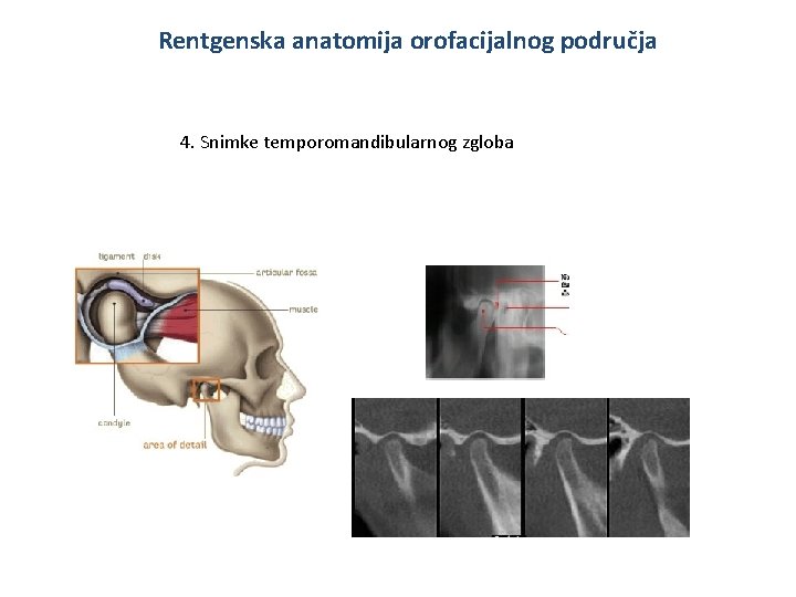 Rentgenska anatomija orofacijalnog područja 4. Snimke temporomandibularnog zgloba 