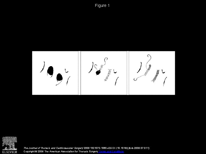 Figure 1 The Journal of Thoracic and Cardiovascular Surgery 2006 1321072 -1080. e 2