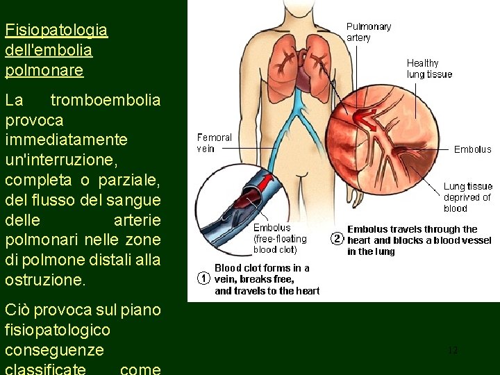 Fisiopatologia dell'embolia polmonare La tromboembolia provoca immediatamente un'interruzione, completa o parziale, del flusso del