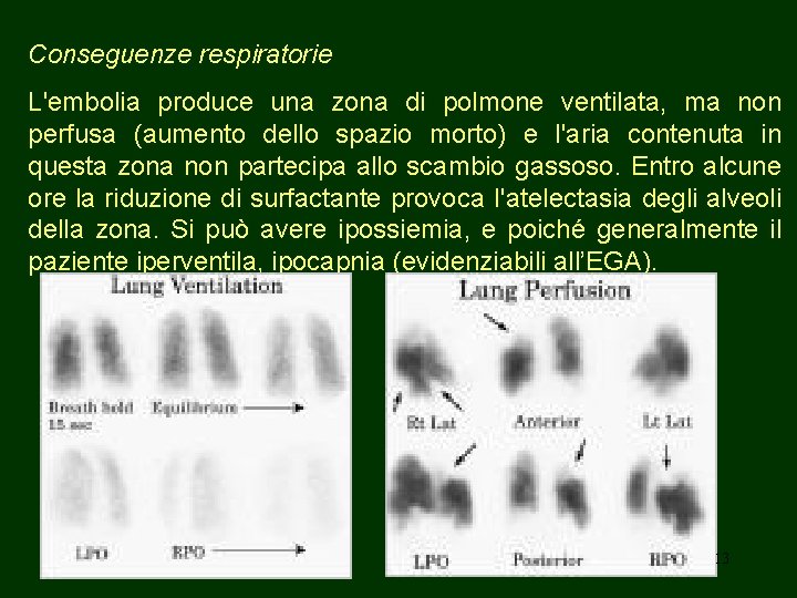 Conseguenze respiratorie L'embolia produce una zona di polmone ventilata, ma non perfusa (aumento dello