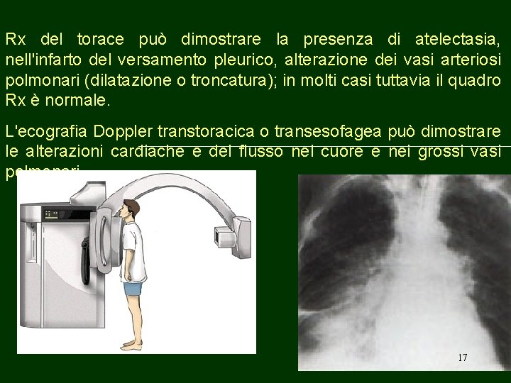 Rx del torace può dimostrare la presenza di atelectasia, nell'infarto del versamento pleurico, alterazione