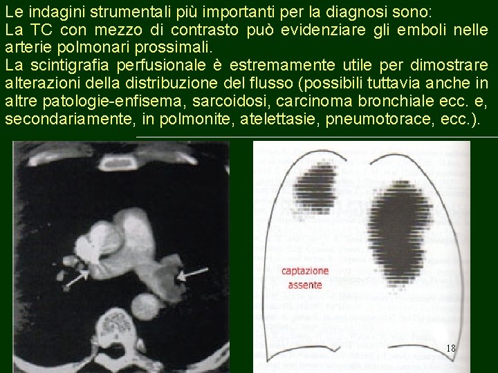 Le indagini strumentali più importanti per la diagnosi sono: La TC con mezzo di