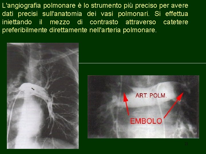 L'angiografia polmonare è lo strumento più preciso per avere dati precisi sull'anatomia dei vasi