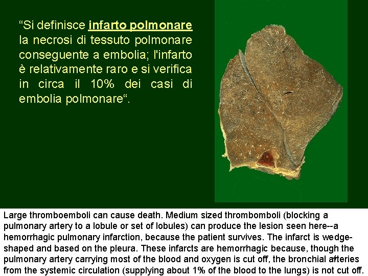 “Si definisce infarto polmonare la necrosi di tessuto polmonare conseguente a embolia; l'infarto è