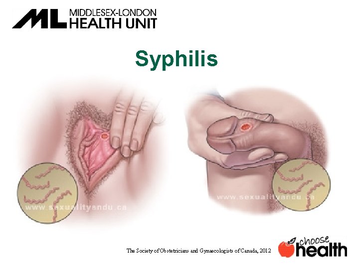 Syphilis The Society of Obstetricians and Gynaecologists of Canada, 2012 