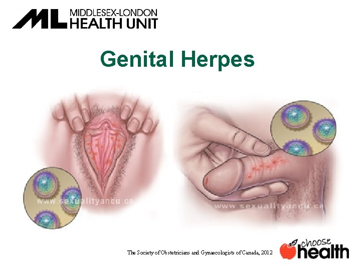 Genital Herpes The Society of Obstetricians and Gynaecologists of Canada, 2012 