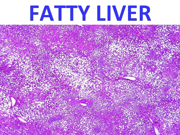 FATTY LIVER 