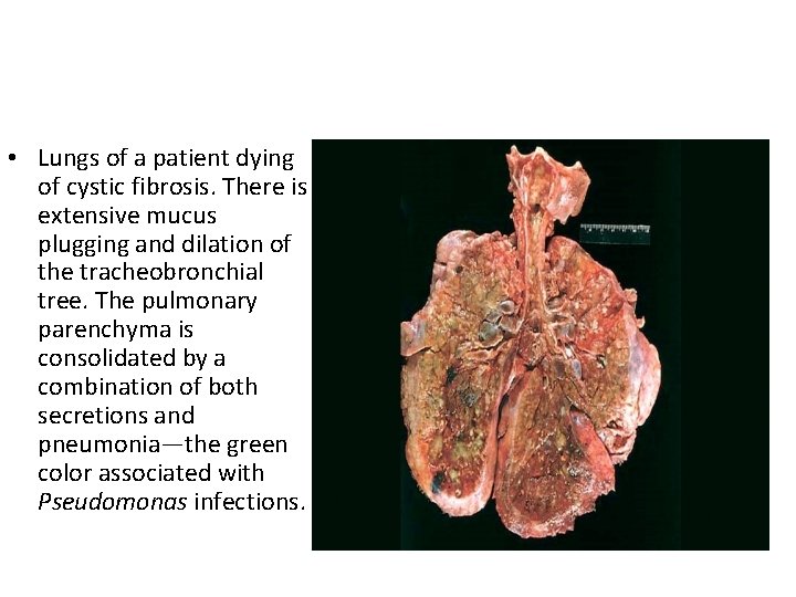  • Lungs of a patient dying of cystic fibrosis. There is extensive mucus
