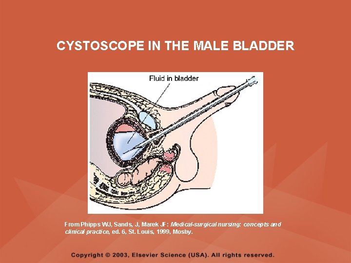 CYSTOSCOPE IN THE MALE BLADDER From Phipps WJ, Sands, J, Marek JF: Medical-surgical nursing: