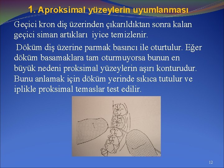 1. Aproksimal yüzeylerin uyumlanması Geçici kron diş üzerinden çıkarıldıktan sonra kalan geçici siman artıkları