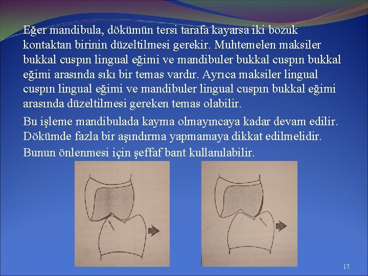 Eğer mandibula, dökümün tersi tarafa kayarsa iki bozuk kontaktan birinin düzeltilmesi gerekir. Muhtemelen maksiler