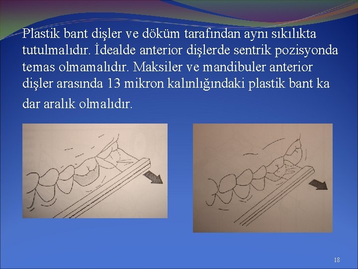 Plastik bant dişler ve döküm tarafından aynı sıkılıkta tutulmalıdır. İdealde anterior dişlerde sentrik pozisyonda