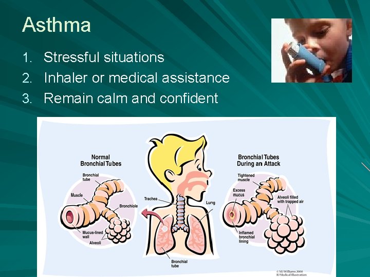 Asthma 1. Stressful situations 2. Inhaler or medical assistance 3. Remain calm and confident