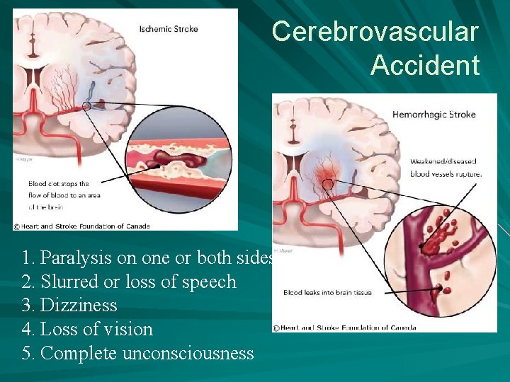 Cerebrovascular Accident 1. Paralysis on one or both sides 2. Slurred or loss of