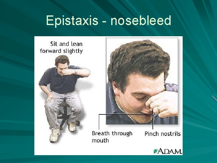 Epistaxis - nosebleed 