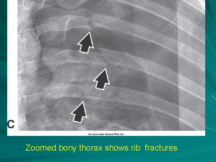 Zoomed bony thorax shows rib fractures 