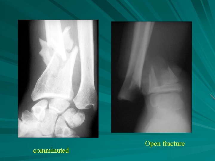 comminuted Open fracture 
