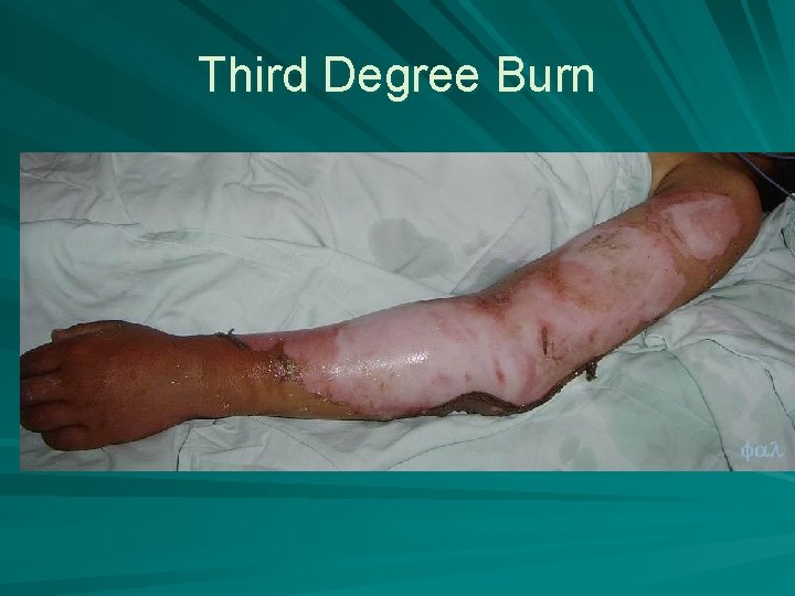Third Degree Burn 
